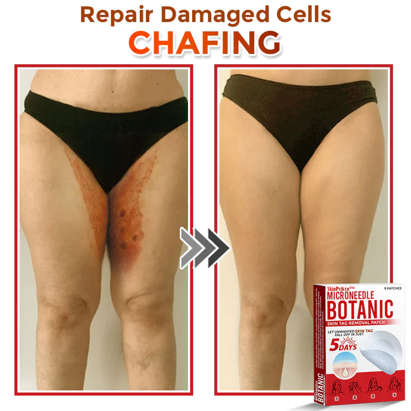🌈 SkinPrikyn™ MicroNeedle Botanic Skin Tag Removal Patch 🇺🇸 Made in the USA