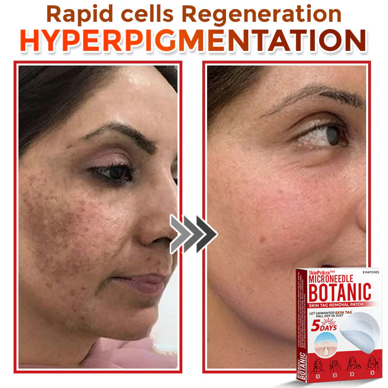 🌈 SkinPrikyn™ MicroNeedle Botanic Skin Tag Removal Patch 🇺🇸 Made in the USA