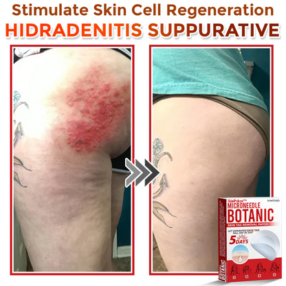 🌈 SkinPrikyn™ MicroNeedle Botanic Skin Tag Removal Patch 🇺🇸 Made in the USA